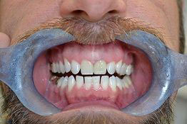 The image shows a man with a full beard wearing a large, blue, plastic dental appliance over his teeth, which appears to be a mouthguard or orthodontic device, with a broad smile revealing the teeth within the appliance.