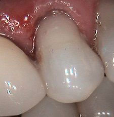 The image shows a close-up view of a person s mouth with teeth, including an upper tooth with a visible cavity and a lower tooth with a large hole, against a pink tongue background.