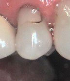 The image shows a close-up view of a person s mouth with teeth and tongue visible, focusing on a dental issue where one tooth appears to be chipped or damaged.