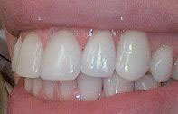 The image shows a close-up of a person s teeth with a smile, highlighting the dental work that includes white fillings and possibly veneers.