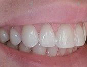 A close-up photograph of a person s mouth with white teeth and a smile, revealing the lower front teeth.