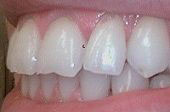The image displays a close-up view of a person s teeth, showing a bright smile with white teeth and clear gums.