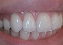 The image shows a close-up of a person s teeth, with a focus on the lower front teeth, which are prominently displayed against a lighter background.