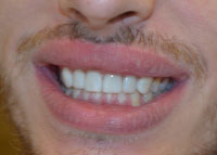 The image shows a close-up of a person s face with an exaggerated smile, displaying their teeth and lips.