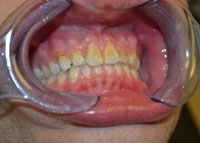 The image shows a person wearing a dental appliance with their mouth open, revealing teeth and gums, against a blurred background.