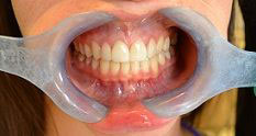 The image shows a person with an open mouth wearing a clear plastic dental appliance, possibly for teeth grinding prevention, with a toothy smile.