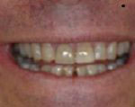 The image shows a person smiling at the camera with a wide open mouth displaying yellowed teeth and a visible tongue piercing.