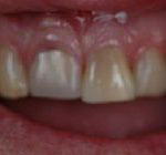The image shows a close-up view of a person s teeth with an open mouth, revealing gums and part of the tongue.