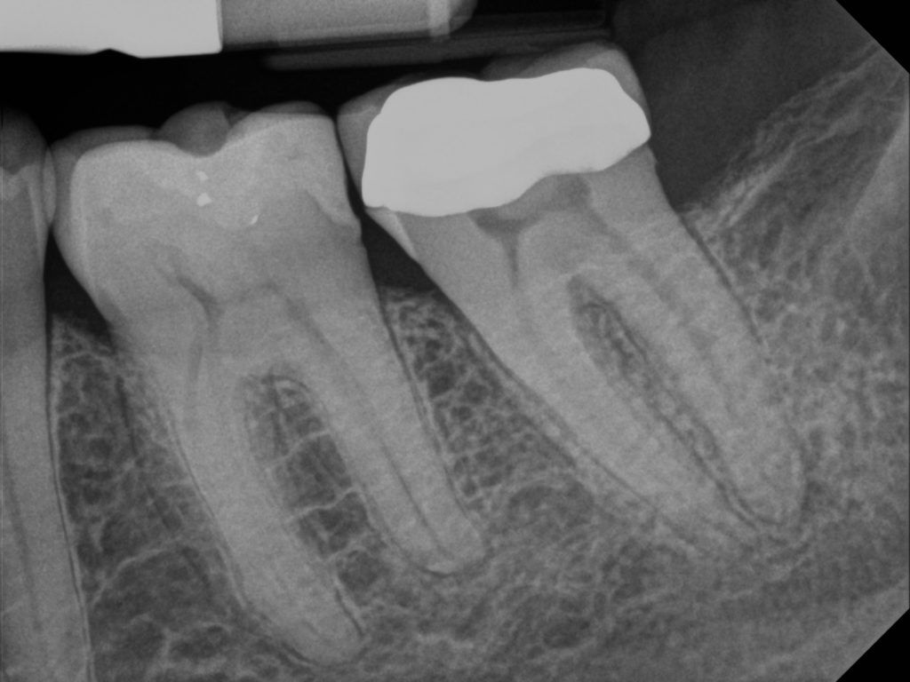 A tooth with a crown before root canal treatment.