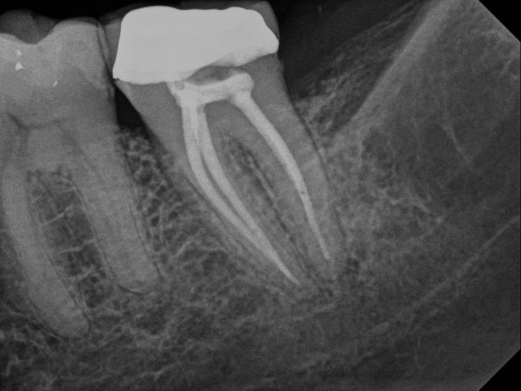 A tooth after the root canal treatment.